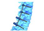 FusePSS - Open Pedicle Screw System