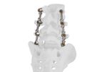 PressON - Multi-Level Spinal Implant