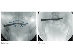 Dysmorphic Sacrum Fixation Treatment with the Curvafix IM System - Case Study