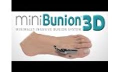 miniBunion 3D - MIS Bunion System with Viking??? Instrumentation - Video