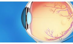 What is Glaucoma? - Video