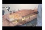 Intellijoint HIP Anterior by Intellijoint Surgical (Full) - Video