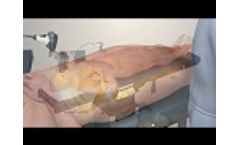 Intellijoint HIP Anterior by Intellijoint Surgical (Full) - Video