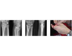 Distal Radius & Distal Ulna Fractures - Case Study