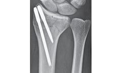 T-Pin - Fixation System for Distal Radius & Distal Ulna Fracture Fixation