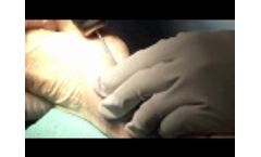 T-Pin Operative Technique - Video