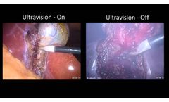 Ultravision - Revolutionary Laparoscopic Surgical Smoke Handling - Alesi Surgical - Video