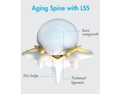 Understanding Lumbar Spinal Stenosis with Neurogenic Claudication