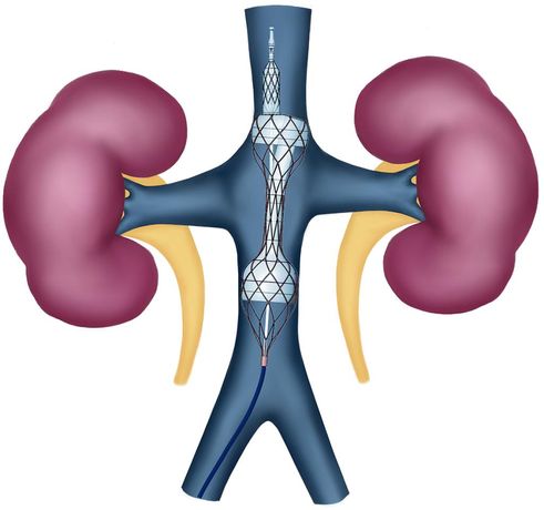 Magenta TRVD Transcatheter Renal Venous Decongestion System