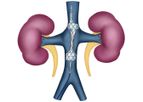 Magenta - Model TRVD - Transcatheter Renal Venous Decongestion System