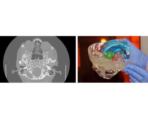 Axial3d - Transforming Treatment Solution for Craniomaxillofacial Neurosurgery