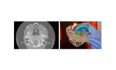 Axial3d - Transforming Treatment Solution for Craniomaxillofacial Neurosurgery