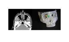 Axial3d - Solution for Craniomaxillofacial Surgery