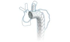 Castor Tevar - Branched Thoracic Stent-Graft System