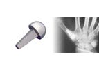 Swanson - Titanium Basal Thumb Implants