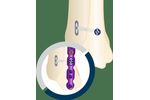 Expert Knotless - Flexible Joint Fixation System
