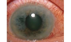 InMed - Model INM-088 - Topical Eye Drop for the Treatment of Glaucoma