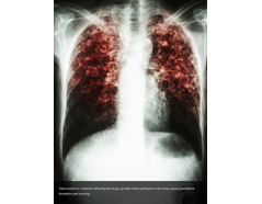 Tuberculosis Treatments - Case Study