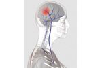 Neuromuscular Electrostimulation Device for VTE Prevention - Acute Stroke- Hospital Applications - Medical / Health Care