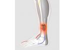 Wound Therapy Applications Device for Venous Leg Ulcers - Medical / Health Care