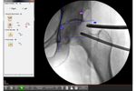 Surgeon Checklist - Version PAO - Minimally-Invasive Solutions for Hip Preservation