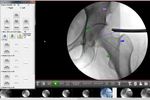 Surgeon Checklist - Version FAI - Minimally-Invasive Solutions for Hip Arthroscopy