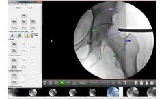 Surgeon Checklist - Version FAI - Minimally-Invasive Solutions for Hip Arthroscopy