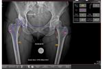 OrthoPlan - Version 2.0 - Dynamic Digital Surgical Planning Software