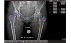 OrthoPlan - Version 2.0 - Dynamic Digital Surgical Planning Software
