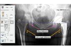 Surgeon Checklist - Version Hip - Achieve Optimal Implant Positioning Using Smart Image Guidance