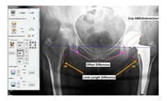 Surgeon Checklist - Version Hip - Achieve Optimal Implant Positioning Using Smart Image Guidance