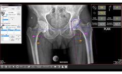 OrthoPlan 2.0 AI-Enabled Pre-Operative Templating Software  - Video