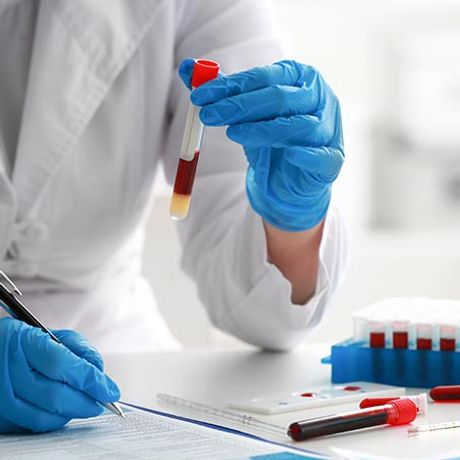 PancreaDix - Non-Invasive Signature in Blood Test Cutting Edge Liquid Biopsy Technology