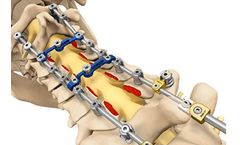 SpineWave Proficient - Posterior Cervical Spine System