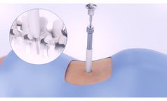 Precision Spine MD-Max Pedicle Screw System - Video
