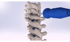 Precision Spine SureLOK PC Posterior Cervical System - Video