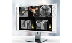 3mensio - Percutaneous Pulmonary Valve Implantation (PPVI)  Planning Software