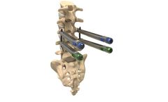 Thunderbolt - Minimally Invasive Pedicle Screw System