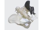 3D Medical - Part Pelvis Replacement