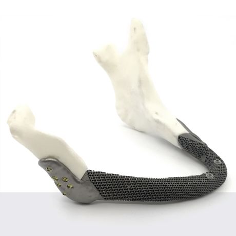 3D Medical - Mandible Implant