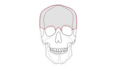 Custom Implant for Protocol Neurosurgery