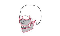 Custom Implant for Protocol Maxillofacial Surgery