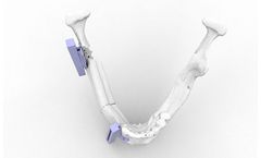 Kune - Model PEEK - Custom Implant for Maxilofacial Surgery