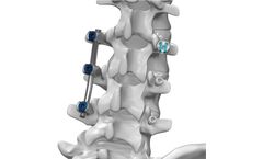 Life Spine - Model ARx - Spinal Fixation System