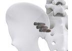 Life Spine - Model SImpact - Sacroiliac Joint Fixation Screw System