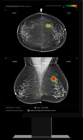 Lunit - Version INSIGHT MMG - AI Solution for Mammography