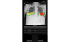Lunit - Version INSIGHT CXR - AI Solution for Chest X-ray