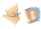 Total Meniscus Replacement Technology
