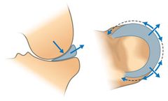 Total Meniscus Replacement Technology