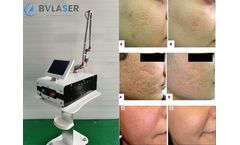CO2 Fractional Laser Scar Removal Equipment In Medical Beauty Industry